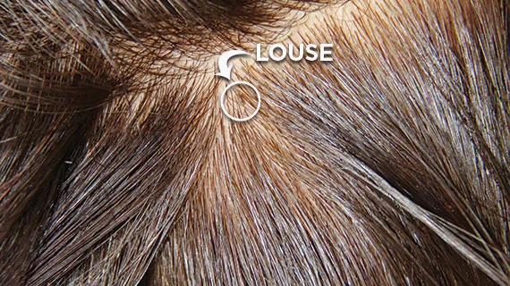 Close up picture of the Louse in hair